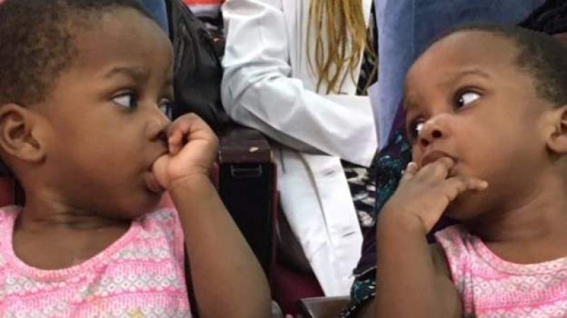 Joy as Nigeria doctors separate conjoined twins