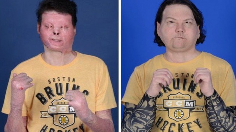 Doctors hail first face and double hand transplant