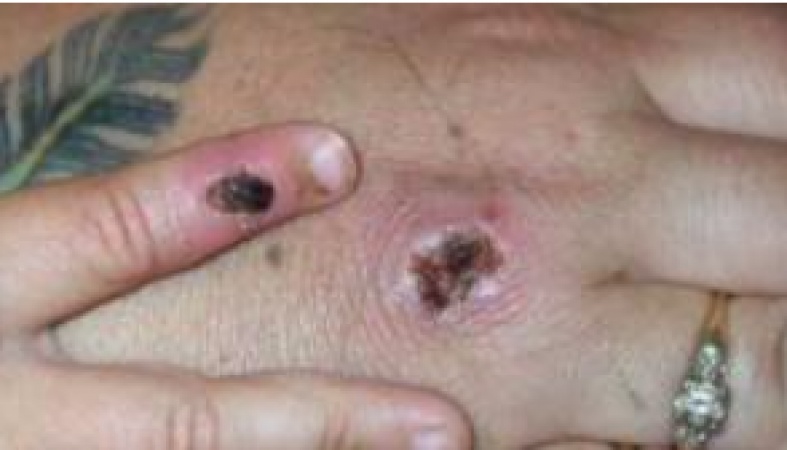 Monkeypox: 80 cases confirmed in 12 countries