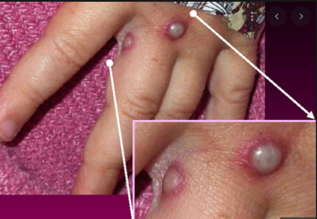'Formidable' challenges as monkeypox spreads - WHO