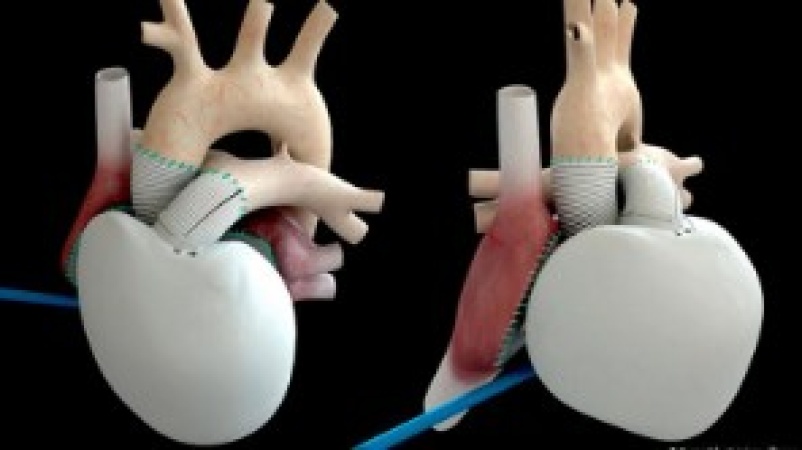 The dream of an artificial heart: how close are we?