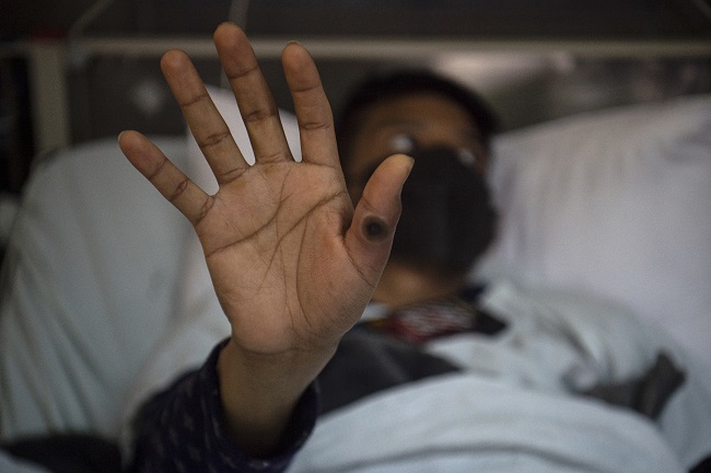 Monkeypox Cases Top 70,000 â€“ WHO